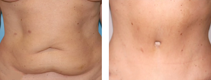 abdominoplastia: cirugía abdominal, reducción de tripa