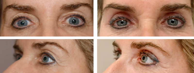 blefaroplastia