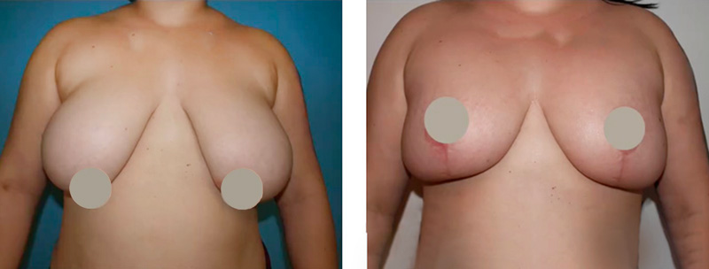 cirugía de reducción de pecho donostia-san sebastián