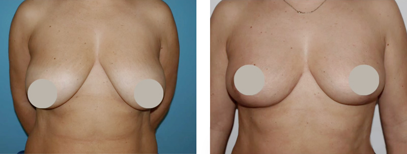 cirugía mamoplastia de reducción de pecho donostia