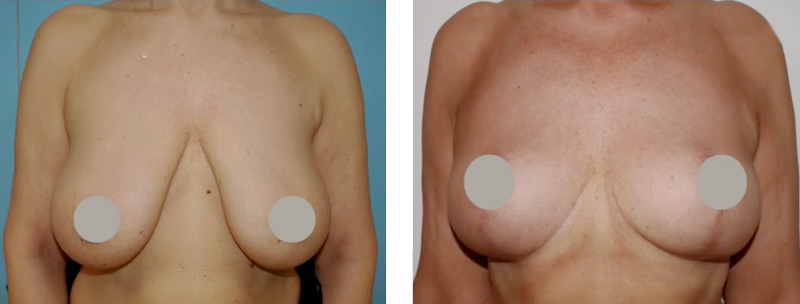 cirugía de reducción de pecho donostia-san sebastián