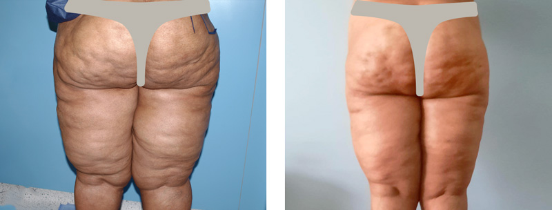 tratamiento lipedema